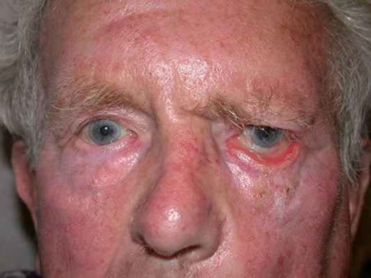 Отхождение слезоотделительных волокон