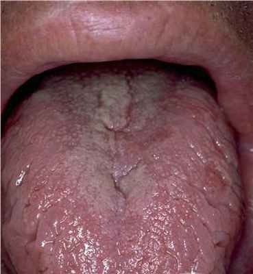 Складчатый язык