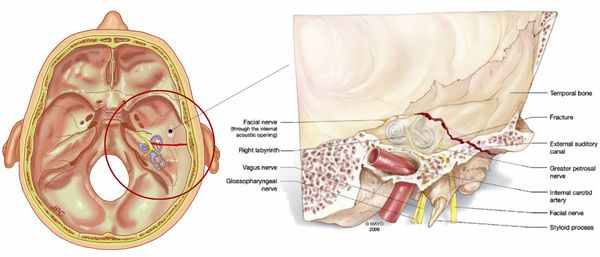 Перелом пирамиды височной кости