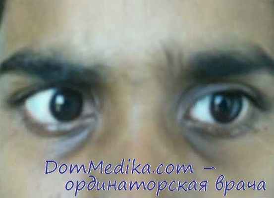 парез взора