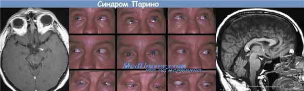 синдром Парино II