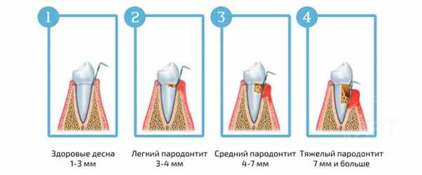 пародонтит.jpg