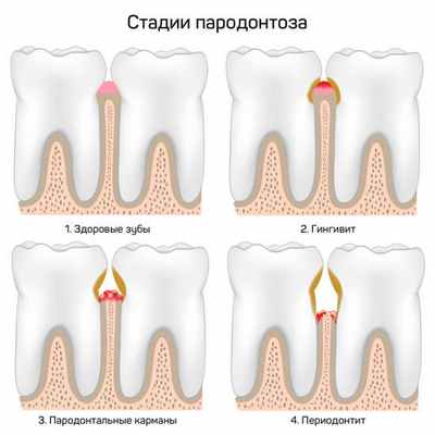 Стадии пародонтита