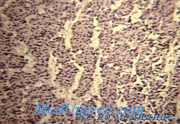 гипофиз при несахарном мочеизнурении