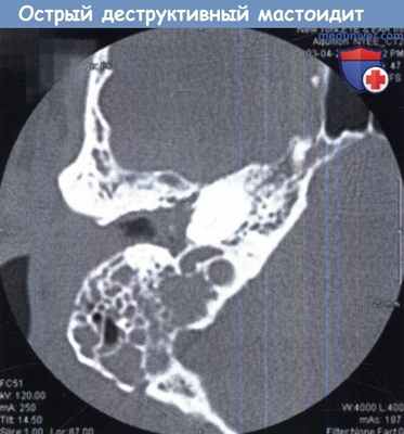 Острый деструктивный мастоидит