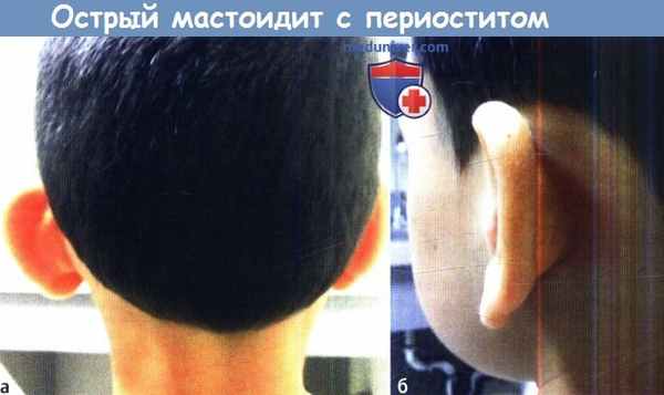Острый мастоидит с периоститом