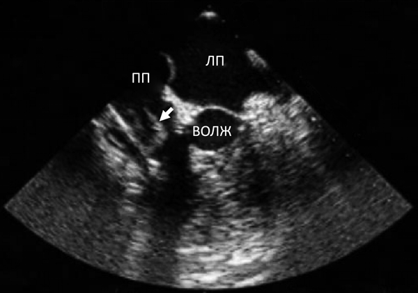 вегетации на электроде кардиостимулятора