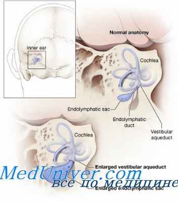 лабиринтопатии