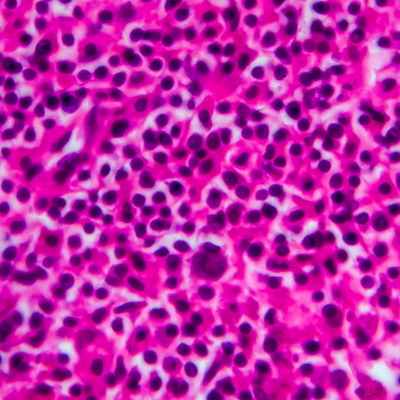 Неходжкинская лимфома