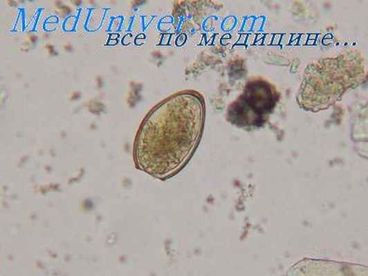 парагонимоз