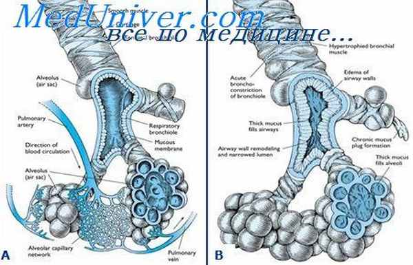 аспергиллез клиника