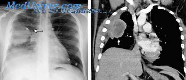 бронхолегочный аспергиллез