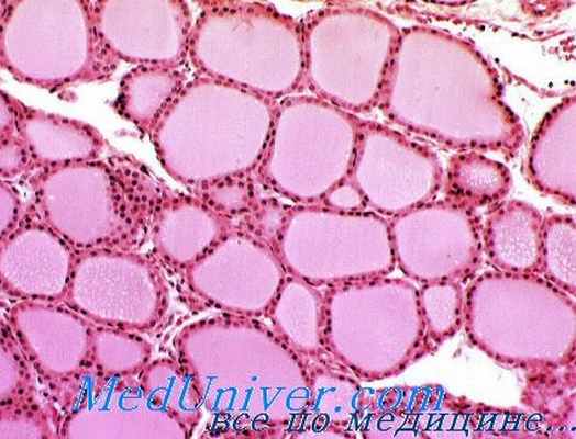 морфология микседемы