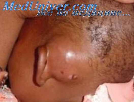 патологическая анатомия мастоидита