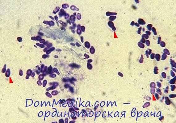 мастоидит - пролиферативный острый отит