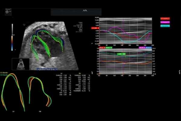 Мультицентровой анализ: возможности оценки деформационных свойств миокарда плода с применением speckle tracking эхокардиографии