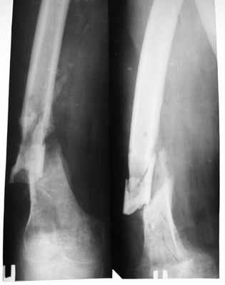 false joint, ложный сустав