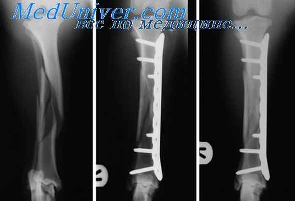 заживление переломов