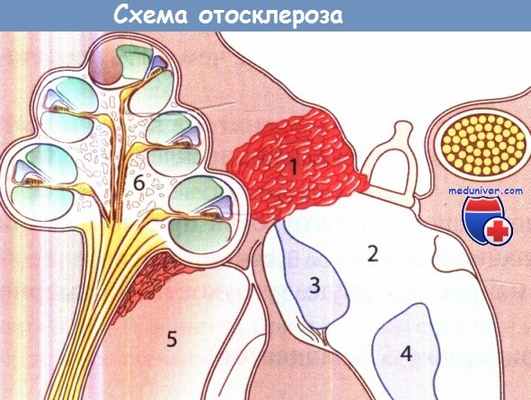Патогенез и патология отосклероза