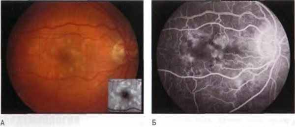 Паттерн-дистрофия
