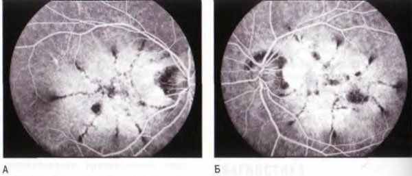Паттерн-дистрофия, порошкообразное глазное дно