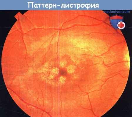 Паттерн-дистрофия макулы