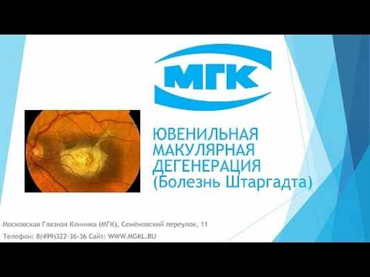 Видео Ювенильная макулярная дегенерация (болезнь Штаргардта)