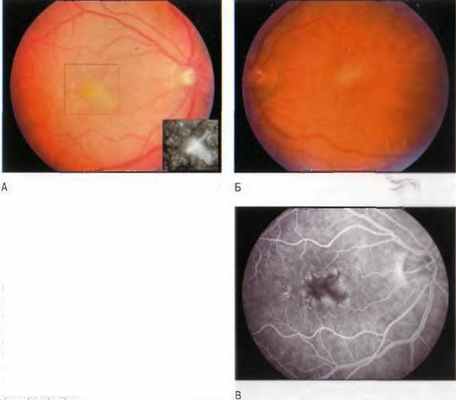 Паттерн-дистрофия представляет собой группу родственных состояний, наследующихся по аутосомнодоминантному типу, и клинически характеризующихся появлением в макуле жёлтых или серых скоплений различной формы.