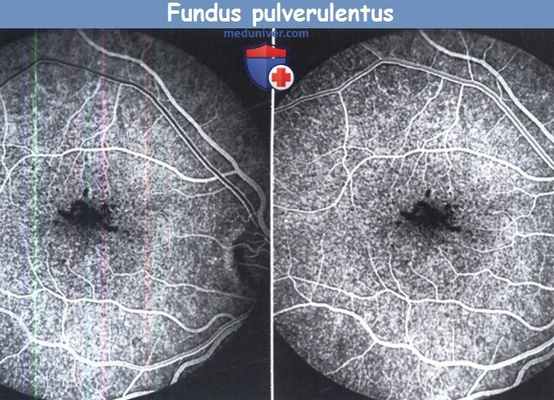 Fundus pulverulentus