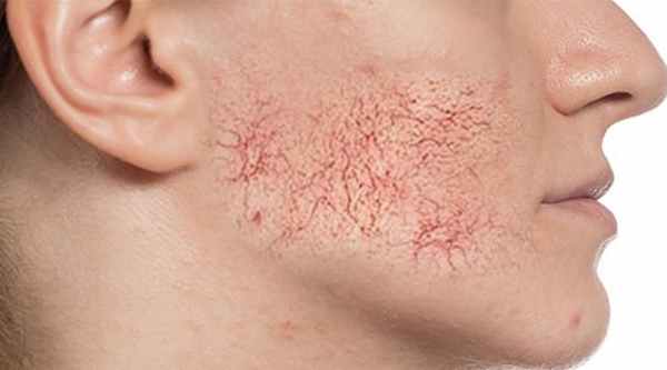 Паукообразная или звездчатая ангиома