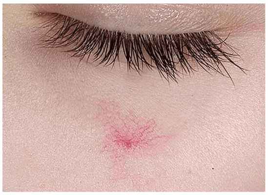 паукообразный невус