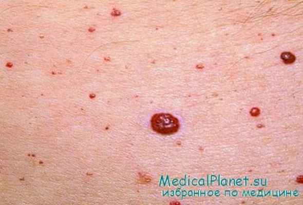 вишневые ангиомы