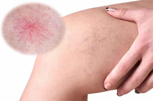 звездчатая гемангиома