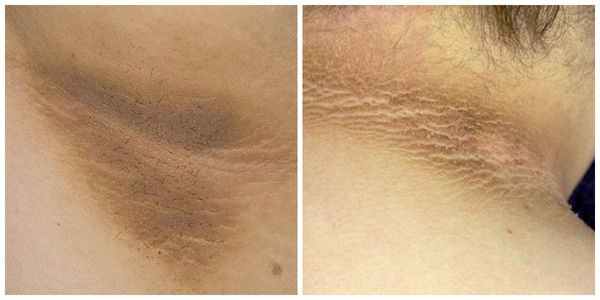 Чёрный акантоз