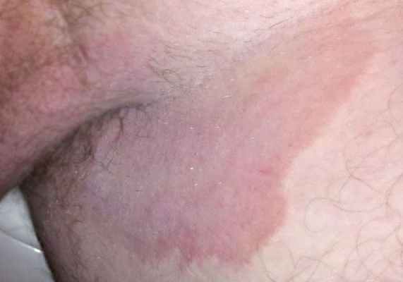 Розовые пятна при паховой эпидермофитии