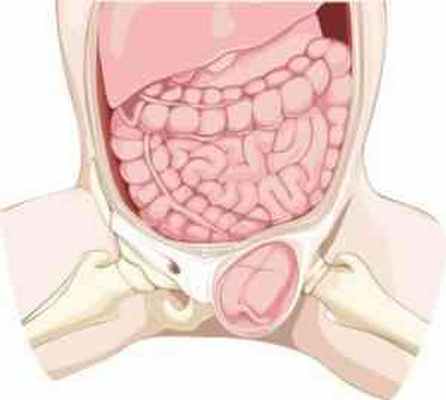 Паховая грыжа