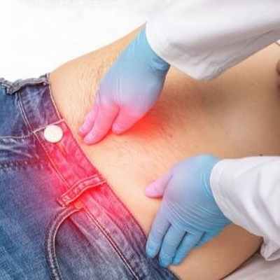 Паховая грыжа