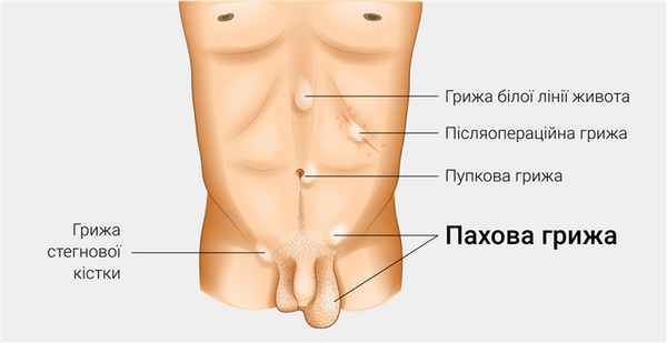 Лечение паховой грыжи