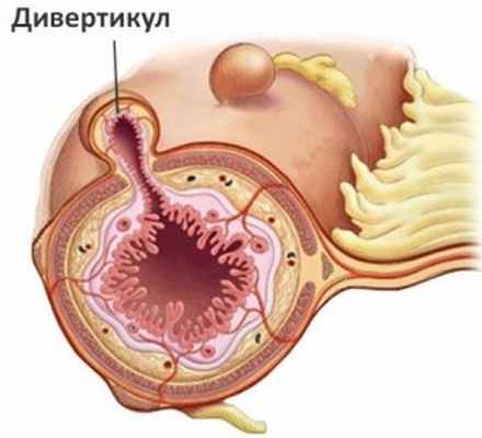 Диагностика дивертикула - медцентр