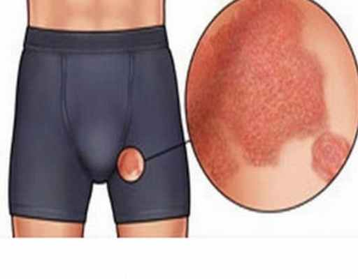 Фото Грибок в паху у мужчин: чем лечить болезнь?