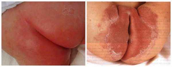 Пелёночный дерматит, осложнённый грибковой инфекцией