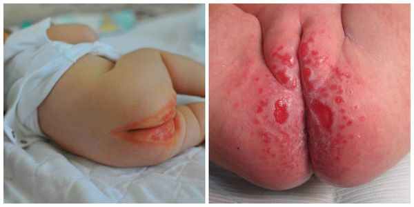 Язвы и эрозии при суперинфекции