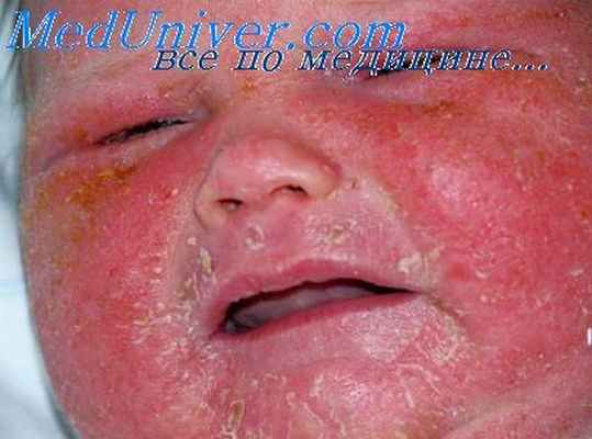 пемфигус новорожденных