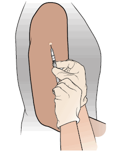 Рисунок 3. Внутрикожная инъекция