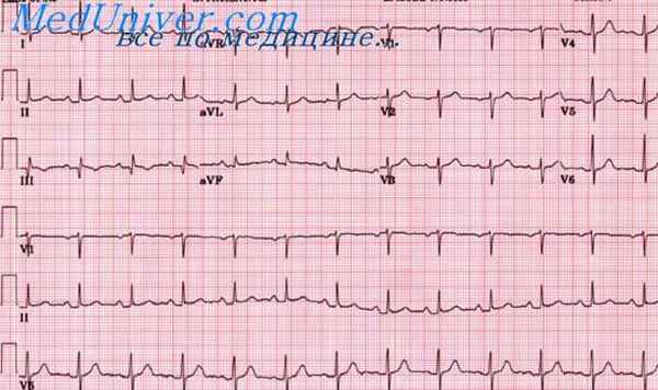 инфаркт миокарда