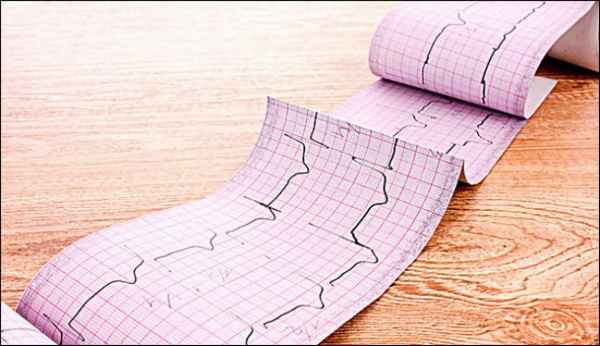 Инфаркт на экг