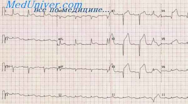 инфаркт миокарда