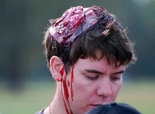 Фото Перелом основания черепа