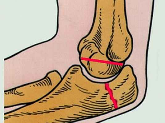 Фото Перелом головки лучевой кости локтевого сустава