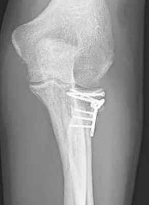 Лечение пациента с многооскольчатым переломом (Тип 3) после падения с горного велосипеда: Комбинированный остеосинтез с применением пластин с угловой стабильностью. Рентген показывает состояние сустава после заживления. 